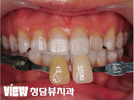 치아미백
